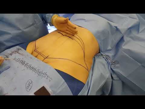 Live Tummy Tuck video